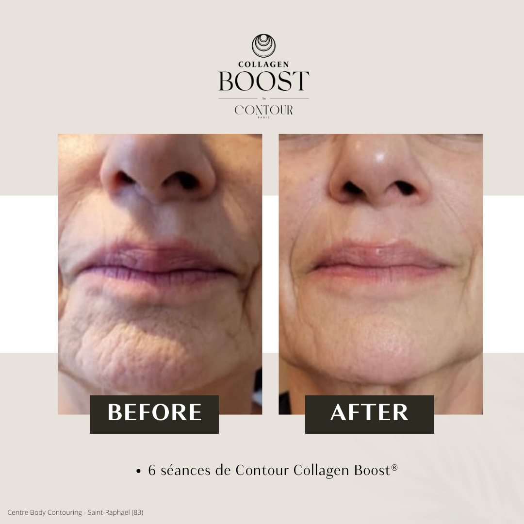 Avant / Après Collagen Boost 2