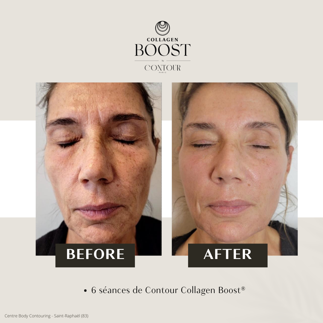 Avant / Après Collagen Boost 5